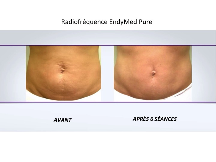 Radiofréquence EndyMed Pure 3 Deep Argenteuil 0