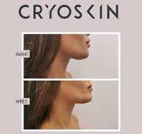 Cryolipolise CryoSkin 2.0 Colombes 0